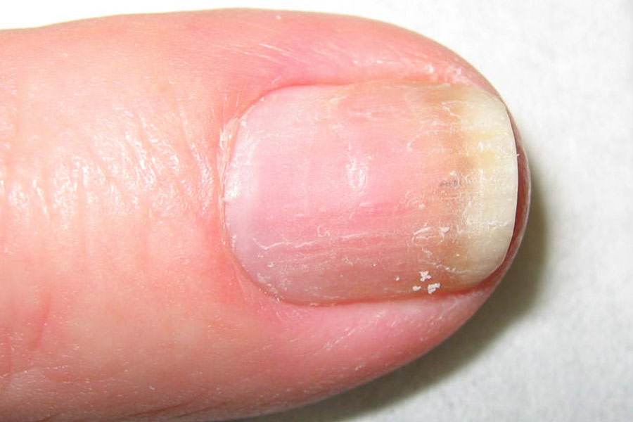 Fingernagel nach Behandlung mit einer NVP