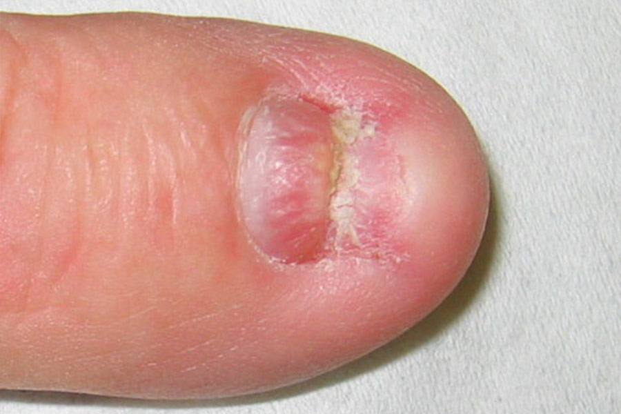 Traumatisierter Fingernagel